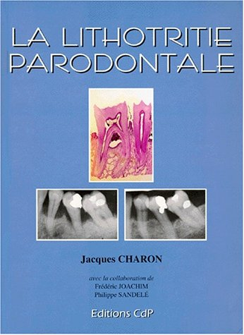 La Lithotritie parodontale