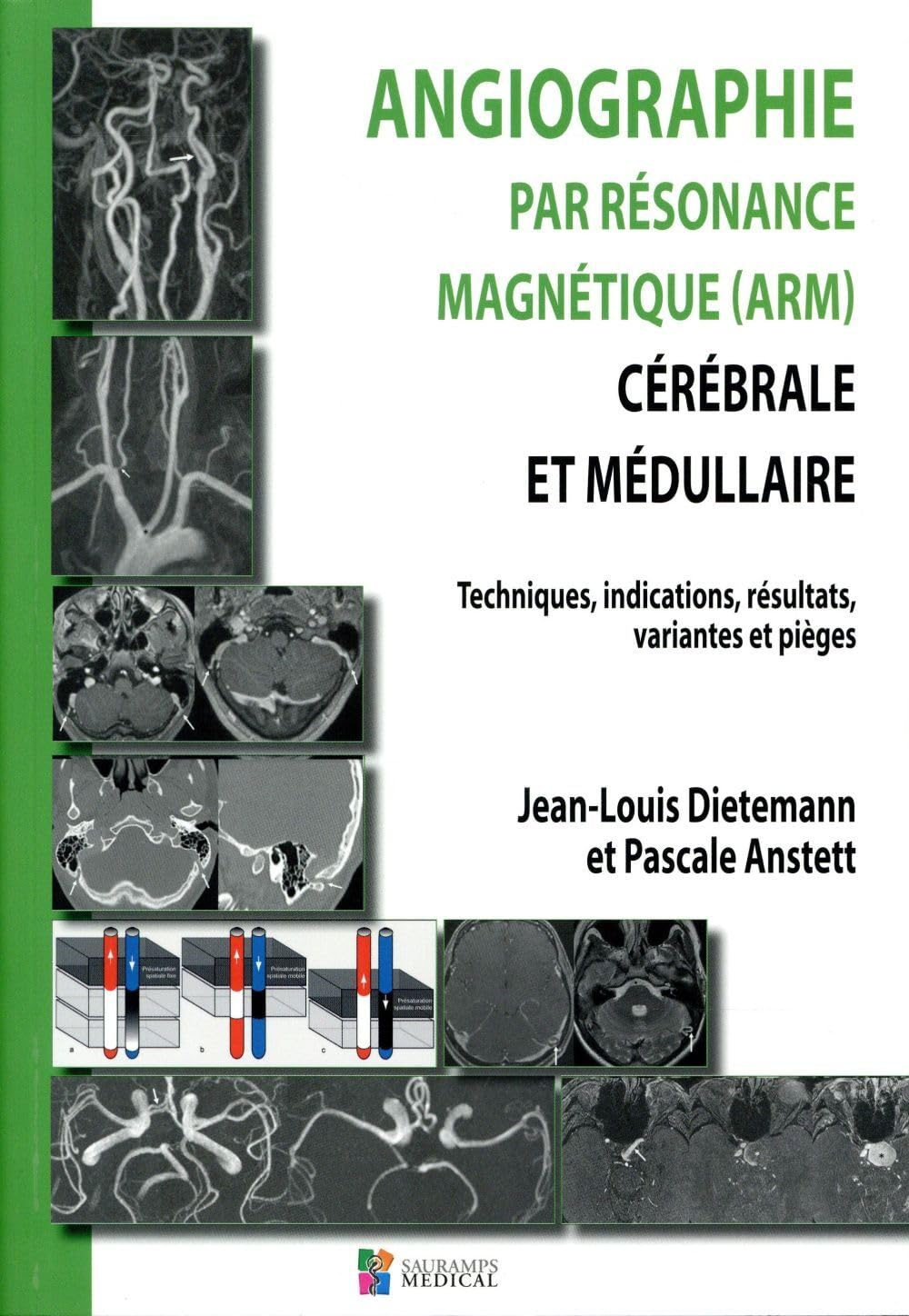 Angiographie par résonance magnétique (ARM) cérébrale et médullaire : techniques, indications, résul