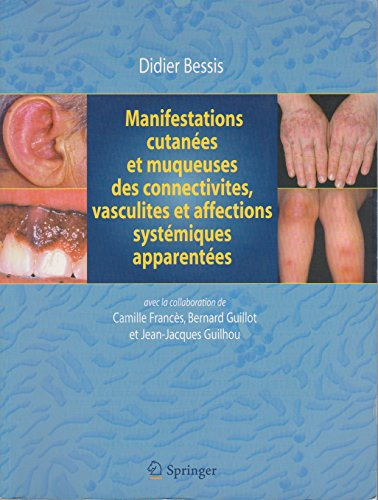 Manifestations cutanées et muqueuses des connectivites, vasculites et affections systémiques apparen