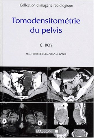 Tomodensitométrie du pelvis