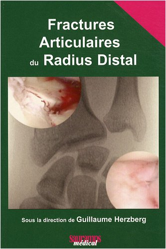Fractures articulaires du radius distal