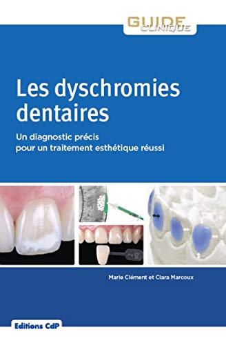 Les dyschromies dentaires : un diagnostic précis pour un traitement esthétique réussi